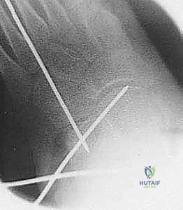 التخطيط لعملية إيفانز الجراحية