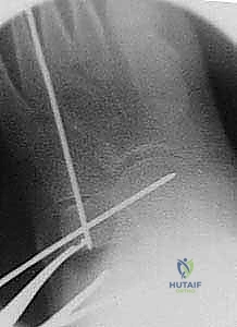صورة توضيحية لـ جراحة إطالة عظم الكعب (عملية إيفانز): الحل الشامل لتصحيح القدم المسطحة وتشوه الكعب الأروح مع الأستاذ الدكتور محمد هطيف في صنعاء