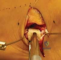 صورة توضيحية لـ جراحة إطالة عظم الكعب (عملية إيفانز): الحل الشامل لتصحيح القدم المسطحة وتشوه الكعب الأروح مع الأستاذ الدكتور محمد هطيف في صنعاء