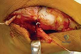 صورة توضيحية لـ جراحة إطالة عظم الكعب (عملية إيفانز): الحل الشامل لتصحيح القدم المسطحة وتشوه الكعب الأروح مع الأستاذ الدكتور محمد هطيف في صنعاء