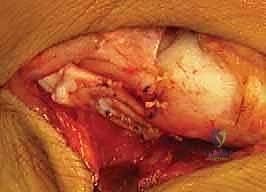 التأكد من التثبيت بالأشعة داخل العمليات