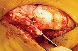 صورة توضيحية لـ جراحة إطالة عظم الكعب (عملية إيفانز): الحل الشامل لتصحيح القدم المسطحة وتشوه الكعب الأروح مع الأستاذ الدكتور محمد هطيف في صنعاء