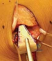 صورة توضيحية لـ جراحة إطالة عظم الكعب (عملية إيفانز): الحل الشامل لتصحيح القدم المسطحة وتشوه الكعب الأروح مع الأستاذ الدكتور محمد هطيف في صنعاء