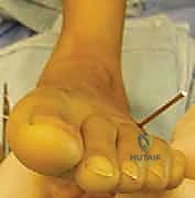 إغلاق الجرح الجراحي بدقة