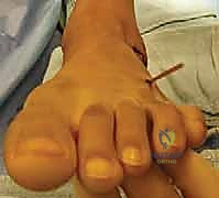 تثبيت العظم باستخدام شريحة ومسامير