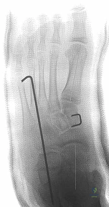 إدخال الطعم العظمي في الفجوة