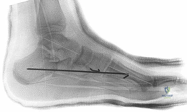 صورة توضيحية لـ جراحة إطالة عظم الكعب (عملية إيفانز): الحل الشامل لتصحيح القدم المسطحة وتشوه الكعب الأروح مع الأستاذ الدكتور محمد هطيف في صنعاء
