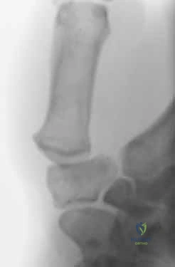 Thumb Carpometacarpal Arthrodesis: An Intraoperative Masterclass for Basal Joint Arthritis