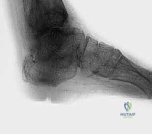 تجهيز المريض لعملية دمج الكاحل