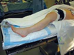 التثبيت النهائي لمفصل الكاحل بالمسامير والصفيحة