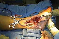 صورة توضيحية لـ دمج مفصل الكاحل والقدم الخلفية بتقنية صفيحة الشفرة الجانبية الحل الأمثل لآلام الكاحل المتقدمة