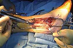 صورة توضيحية لـ دمج مفصل الكاحل والقدم الخلفية بتقنية صفيحة الشفرة الجانبية الحل الأمثل لآلام الكاحل المتقدمة