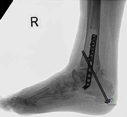 Illustration of blade plate fixation - Dr. Mohammed Hutaif