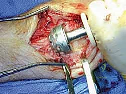 دمج مفصل الكاحل والقدم الخلفية بتقنية صفيحة الشفرة الجانبية الحل الأمثل لآلام الكاحل المتقدمة