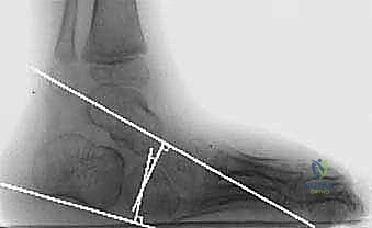 إطالة وتر أخيل بالانزلاق المفتوح: حل دائم لتشوه القدم الحنفاء مع الأستاذ الدكتور محمد هطيف
