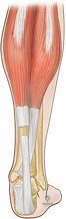 خياطة الوتر بعد تحقيق الاستطالة المطلوبة