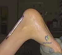 تشريح الأنسجة والوصول إلى وتر أخيل