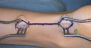 صورة توضيحية لـ إطالة وتر أخيل بالانزلاق المفتوح: حل دائم لتشوه القدم الحنفاء مع الأستاذ الدكتور محمد هطيف