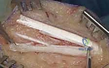 صورة توضيحية لـ إطالة وتر أخيل بالانزلاق المفتوح: حل دائم لتشوه القدم الحنفاء مع الأستاذ الدكتور محمد هطيف