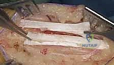 تحديد مسار الشق الجراحي بدقة