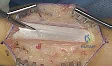 وضع الجبيرة الجبسية لتثبيت النتيجة