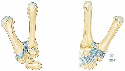 صورة توضيحية لـ جراحة مفصل إبهام اليد بالتعليق الوتري FCR: حل فعال لخشونة الإبهام مع الأستاذ الدكتور محمد هطيف في صنعاء