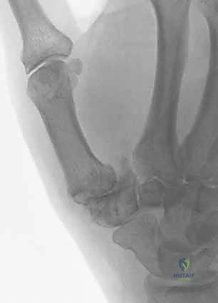 تصوير الأشعة السينية لتشخيص خشونة مفصل الإبهام