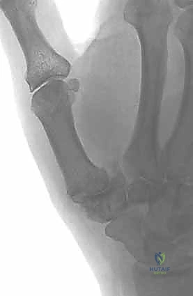 تأثير العوامل الميكانيكية على تآكل غضروف الإبهام