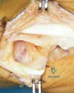 خطوات استئصال العظم المربعي في جراحة اليد