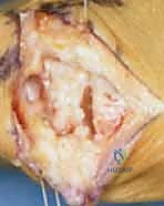 الخيارات غير الجراحية لعلاج ألم الإبهام