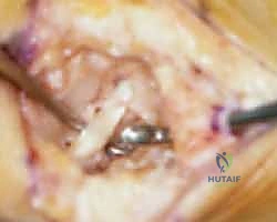 تمرير الوتر لضمان استقرار مفصل الإبهام الجديد