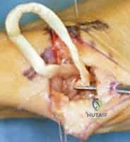 تجهيز وتر الرسغ الكعبري المرن FCR للتعليق