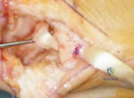 جراحة مفصل إبهام اليد بالتعليق الوتري FCR: حل فعال لخشونة الإبهام مع الأستاذ الدكتور محمد هطيف في صنعاء