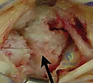 صورة توضيحية لـ جراحة مفصل إبهام اليد بالتعليق الوتري FCR: حل فعال لخشونة الإبهام مع الأستاذ الدكتور محمد هطيف في صنعاء