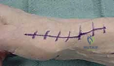 صورة توضيحية لـ جراحة مفصل إبهام اليد بالتعليق الوتري FCR: حل فعال لخشونة الإبهام مع الأستاذ الدكتور محمد هطيف في صنعاء