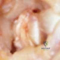 صورة توضيحية لـ جراحة مفصل إبهام اليد بالتعليق الوتري FCR: حل فعال لخشونة الإبهام مع الأستاذ الدكتور محمد هطيف في صنعاء