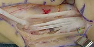 صورة توضيحية لـ جراحة مفصل إبهام اليد بالتعليق الوتري FCR: حل فعال لخشونة الإبهام مع الأستاذ الدكتور محمد هطيف في صنعاء