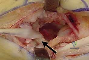 صورة توضيحية لـ جراحة مفصل إبهام اليد بالتعليق الوتري FCR: حل فعال لخشونة الإبهام مع الأستاذ الدكتور محمد هطيف في صنعاء