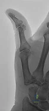 Illustration of base of the metacarpal - Dr. Mohammed Hutaif