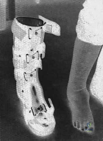 الخيارات العلاجية لتشوهات الكاحل وتقييم الحالة