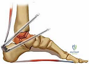 تقرحات وتشوهات القدم الناتجة عن فشل جراحي أو إهمال