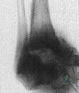اعتلال شاركو العصبي المفصلي وتدمير العظام