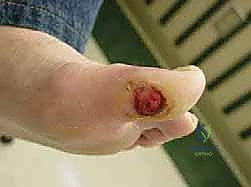 استخدام الأشعة المباشرة لتقييم العظام