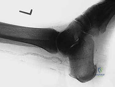 الشق الجراحي للوصول إلى مفصل الكاحل