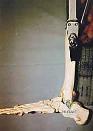 تورم واحمرار الكاحل وفقدان الغضاريف