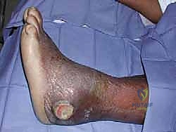 تشوه الكاحل المعقد وفقدان التوازن الهيكلي