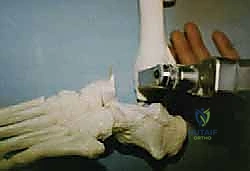 تجهيز السطح العظمي للالتحام