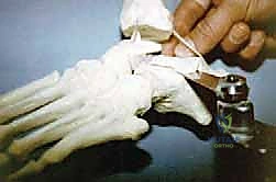 كشف العظام التالفة داخل المفصل