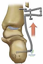 تحضير عظمة الكعب لاستقبال الصفيحة النصلية