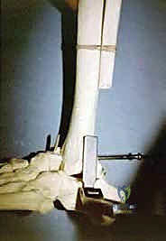 التأكد من التطابق المثالي بين العظمتين